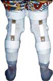 زانو بندAnti Requrvatum Knee Eage